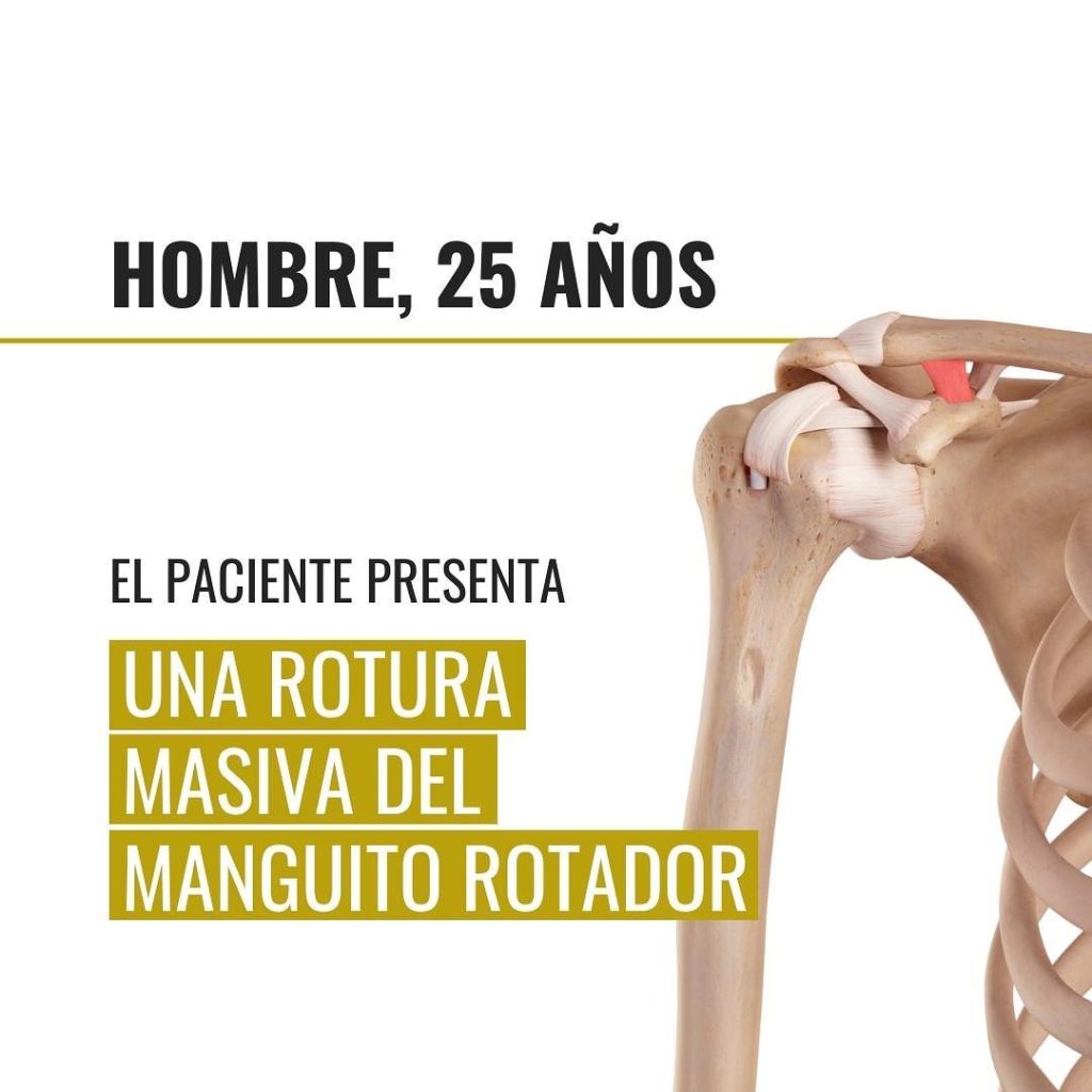 Rotura manguito rotador