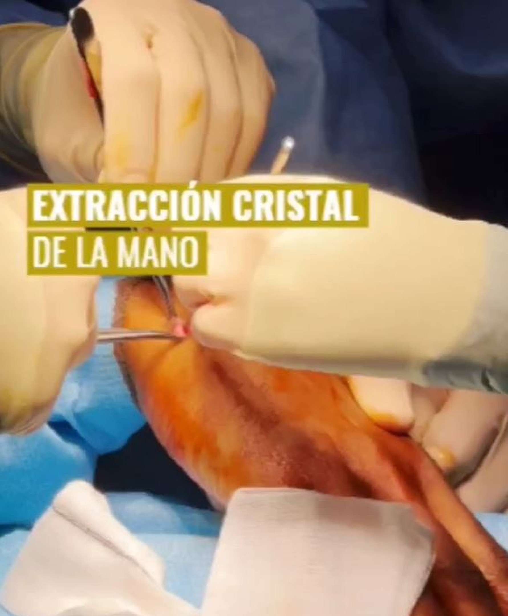 Extracción de un cristal de la mano