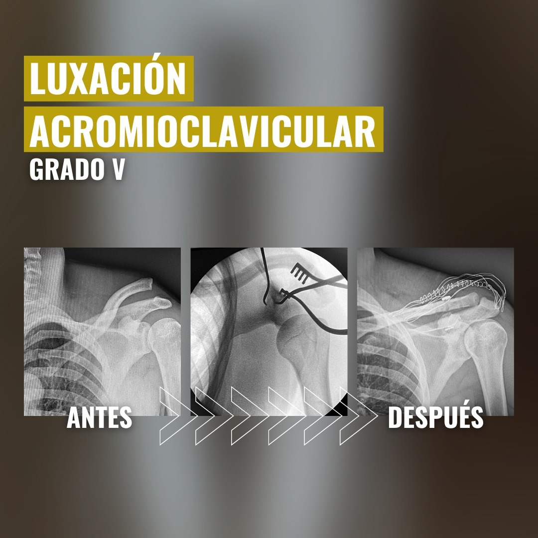 Luxación acromioclavicular