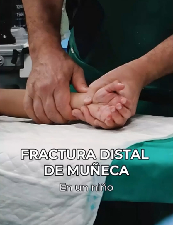 Fractura distal de muñeca