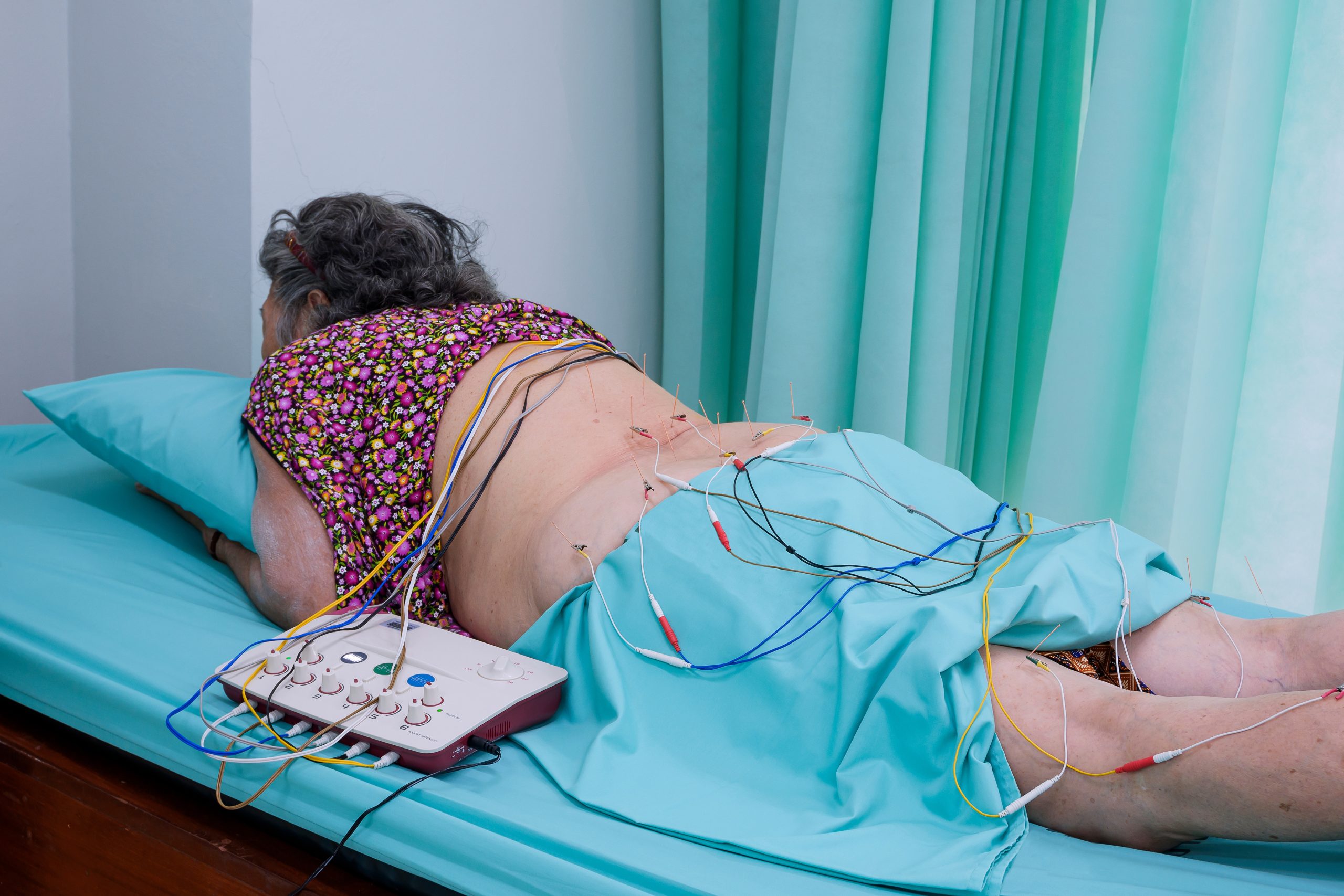Neuromodulación nerviosa con estimulación eléctrica