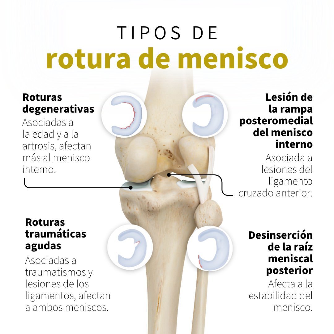 rotura de menisco