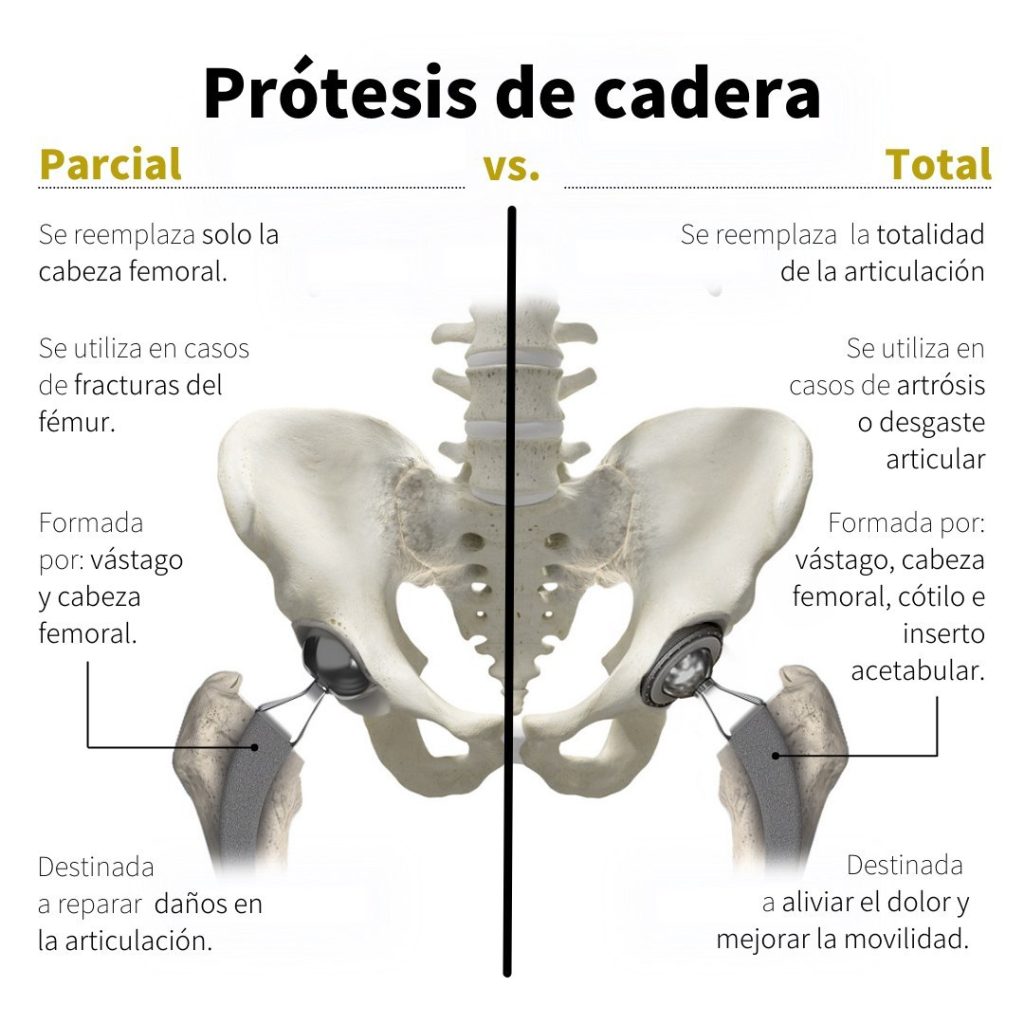 Explicación prótesis de cadera
