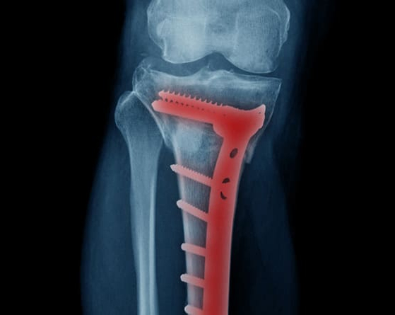 Osteotomía de rodilla