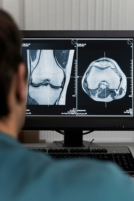 Osteotomía de rodilla